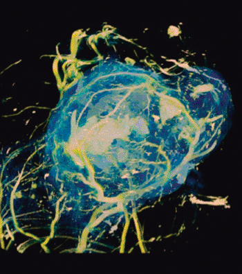 Image: MRI detecting the uptake of sugar in tumors (Photo courtesy of UCL). Image: MRI detecting the uptake of sugar in tumors (Photo courtesy of UCL).